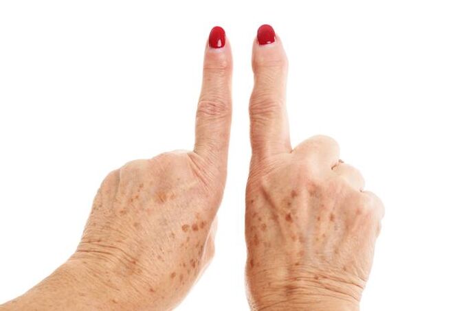 deformierende Arthrose in den Fingern