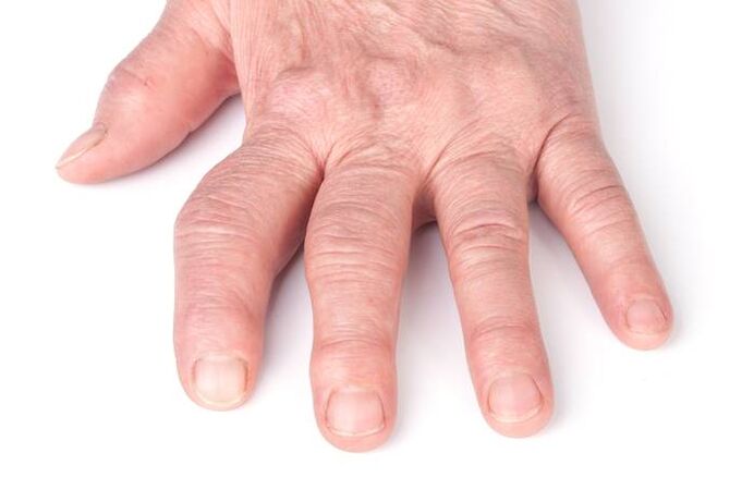 deformierende Arthrose in den Händen