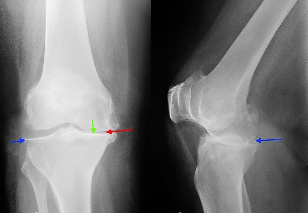 Röntgenbild einer Arthrose des Kniegelenks. 