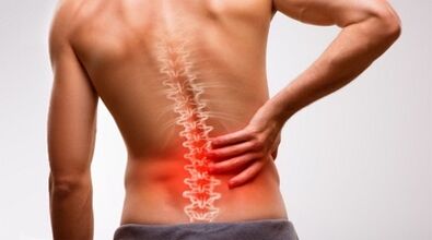 Anzeichen und Symptome der Osteochondrose der Lumbalsäule