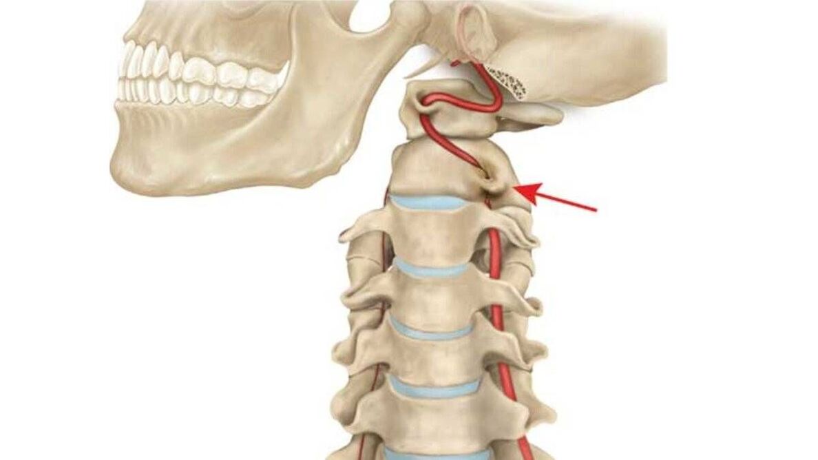 Osteochondrose der Halswirbelsäule