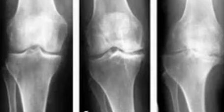 Gonarthrose 3 Grad