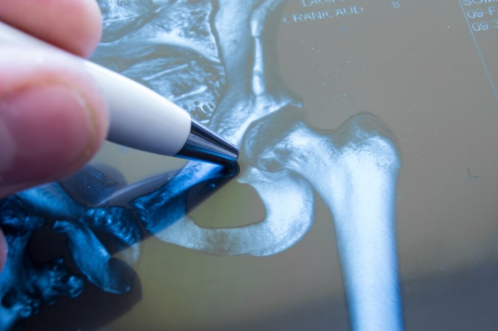 Arthrose des Hüftgelenks im Röntgenbild. 