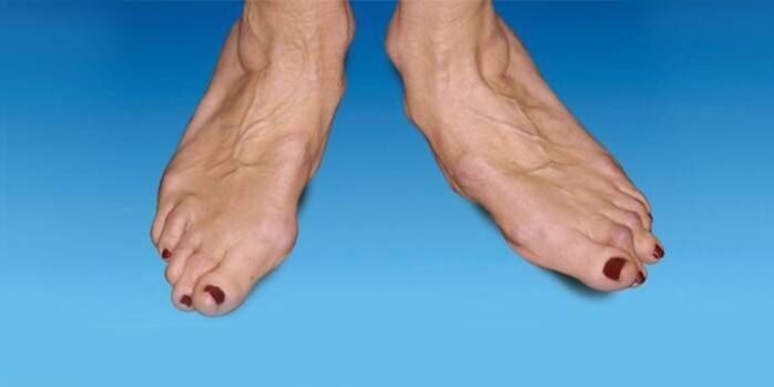 Fußdeformität bei Sprunggelenksarthrose